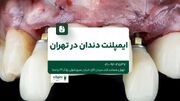 ایمپلنت دندان در تهران