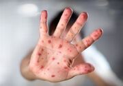 شناسایی ۶۷۴ مبتلا به "سرخک"؛ شیوع در ۳ کشور همسایه