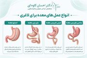 انواع عمل های معده برای لاغری
