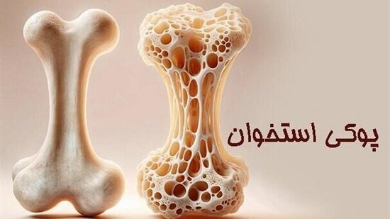 پوکی استخوان؛ تشخیص و درمان به موقع
