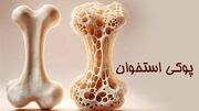 ضرورت ارزیابی دقیق خطر شکستگی و انتخاب درمان متناسب با وضعیت هر بیمار
