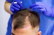 چرا ریزش مو در ناحیه شقیقه بیشتر دیده می‌شود و آیا کاشت مو راه‌حل مناسبی است؟