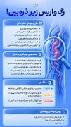 رگ‌های واریسی زیر ذره‌بین!
