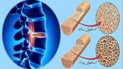 استعمال دخانیات و مصرف کورتون سبب افزیش احتمال ابتلا به پوکی استخوان می‌شود
