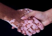 نتایج امیدوارکننده درمان پیسی با سلول‌های بنیادی در شیراز